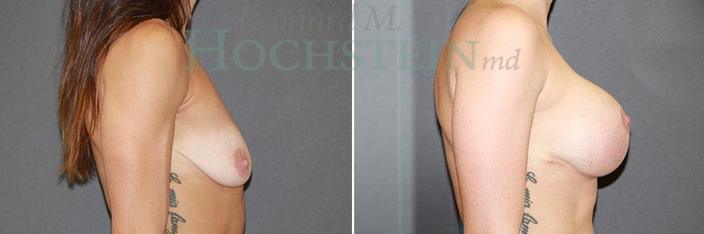 Breast Lift With Implants Patient