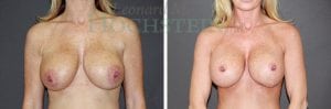 Breast Lift With Implants Patient