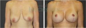 Breast Lift With Implants Patient