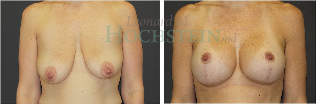Breast Lift With Implants Patient