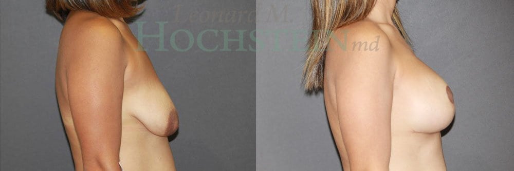 Breast Lift With Implants Patient