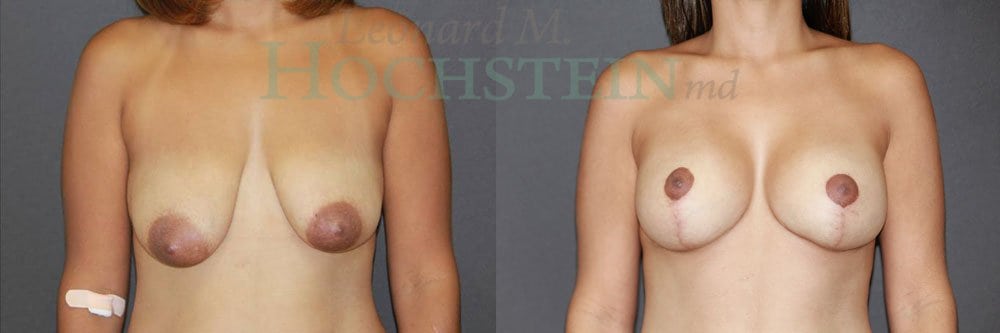 Breast Lift With Implants Patient