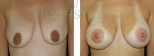 Breast Lift Patient 25