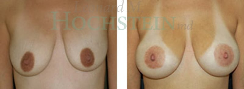 Breast Lift With Implants Patient
