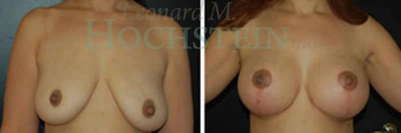 Breast Lift With Implants Patient
