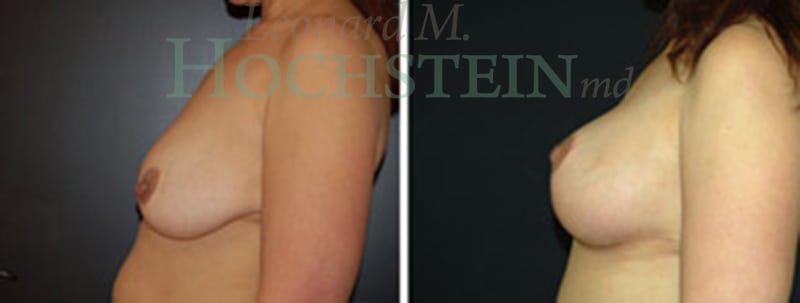 Breast Lift With Implants Patient