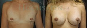 Breast Lift With Implants Patient
