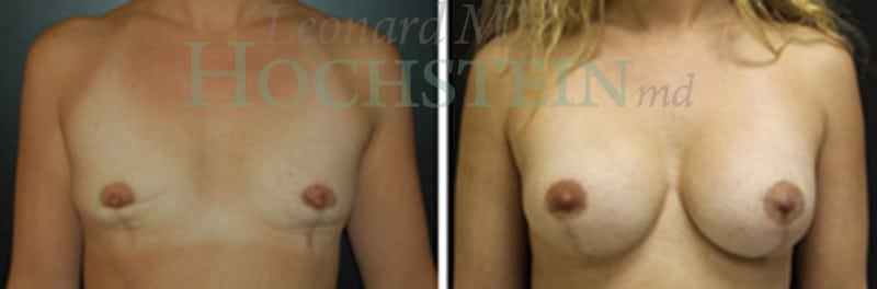 Breast Lift With Implants Patient