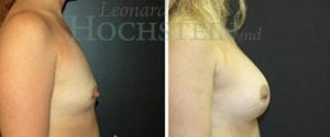 Breast Lift With Implants Patient