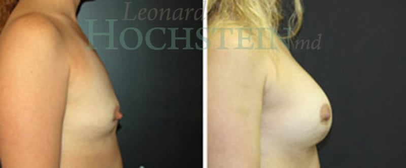Breast Lift With Implants Patient