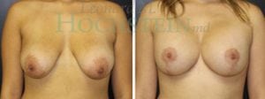 Breast Lift With Implants Patient