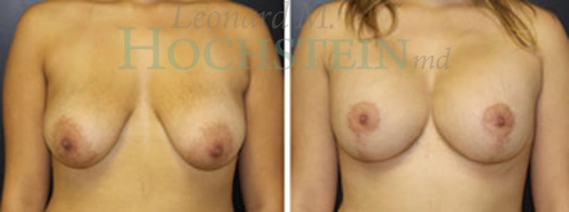 Breast Lift With Implants Patient