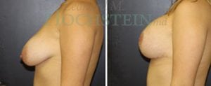 Breast Lift With Implants Patient
