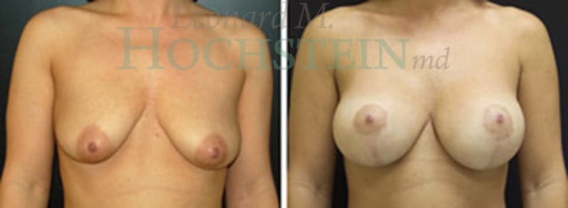 Breast Lift With Implants Patient