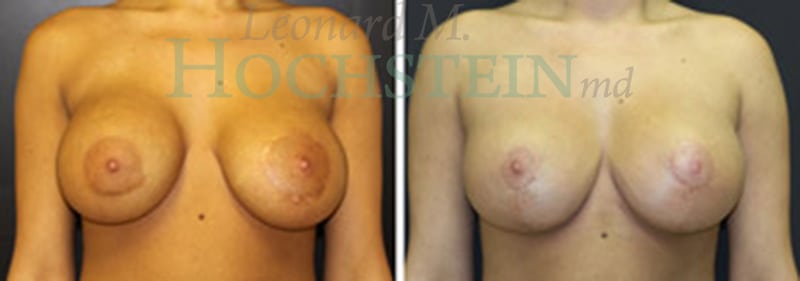 Breast Lift With Implants Patient