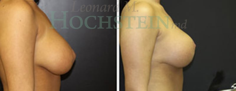 Breast Lift With Implants Patient