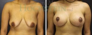 Breast Lift With Implants Patient