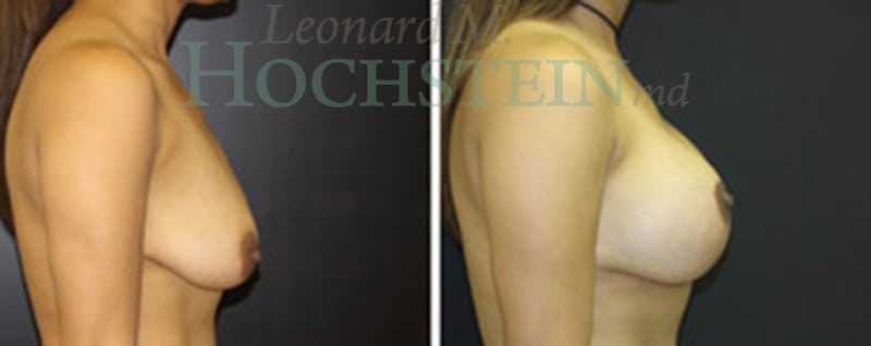 Breast Lift With Implants Patient