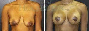 Breast Lift With Implants Patient