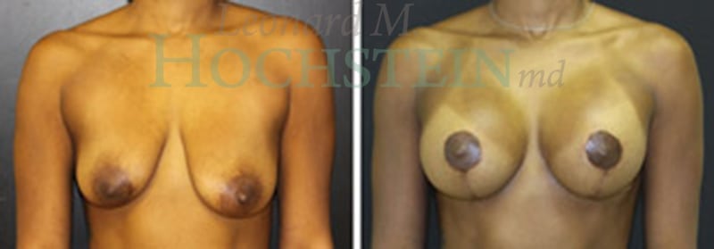 Breast Lift With Implants Patient