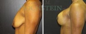 Breast Lift With Implants Patient