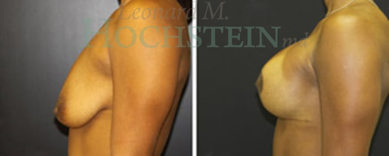 Breast Lift With Implants Patient