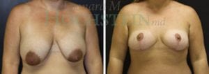 Breast Lift With Implants Patient