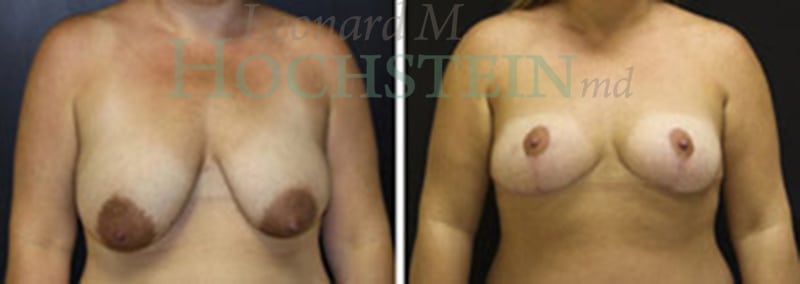 Breast Lift With Implants Patient