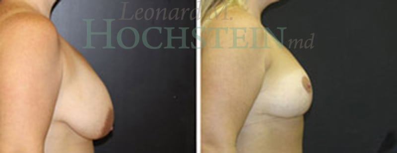 Breast Lift With Implants Patient