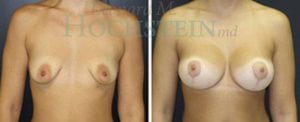 Breast Lift With Implants Patient