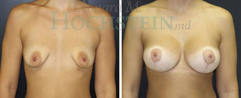 Breast Lift With Implants Patient
