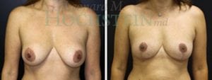 Breast Lift With Implants Patient