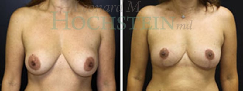 Breast Lift With Implants Patient