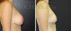 Breast Lift With Implants Patient