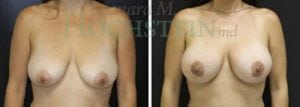Breast Lift With Implants Patient