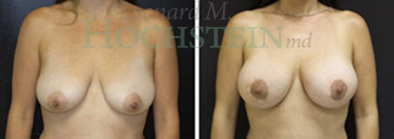 Breast Lift With Implants Patient