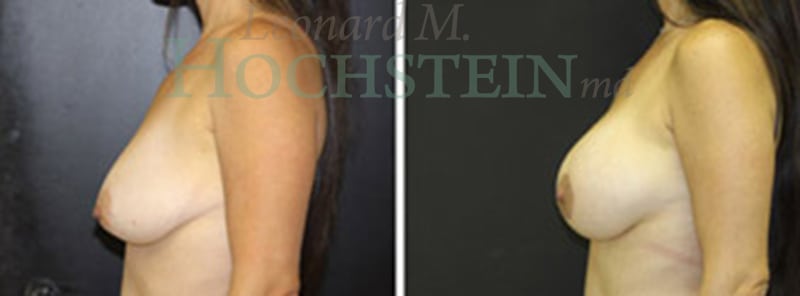 Breast Lift With Implants Patient