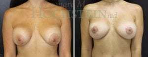 Breast Lift With Implants Patient