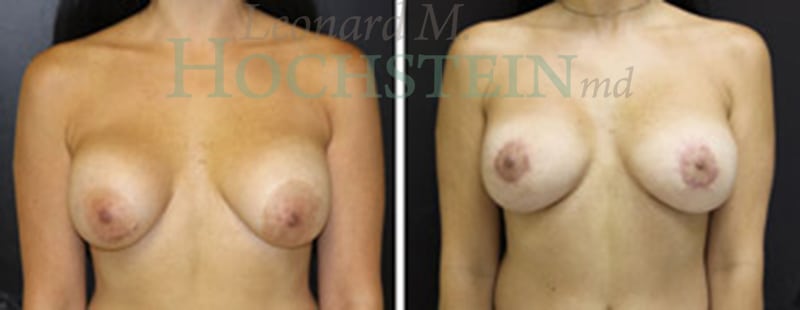 Breast Lift With Implants Patient