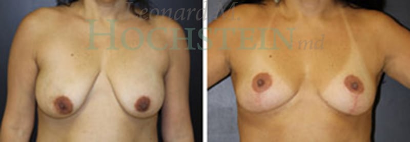 Breast Lift With Implants Patient