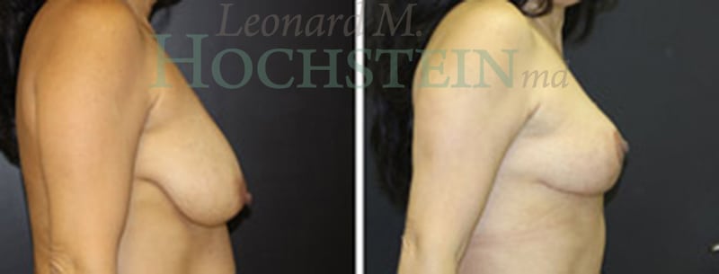 Breast Lift With Implants Patient
