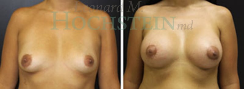 Breast Lift With Implants Patient