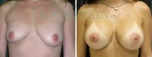 Breast Lift With Implants Patient