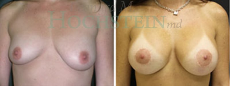 Breast Lift With Implants Patient