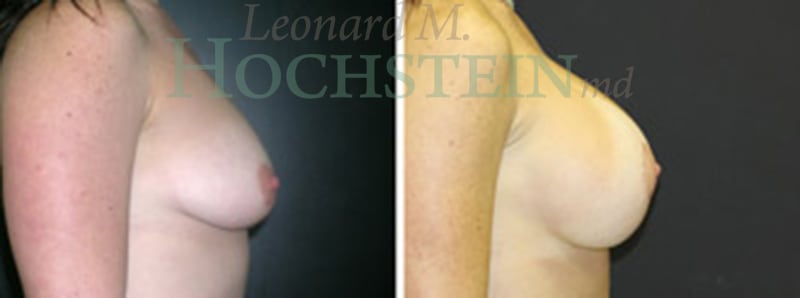 Breast Lift With Implants Patient