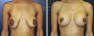 Breast Lift With Implants Patient