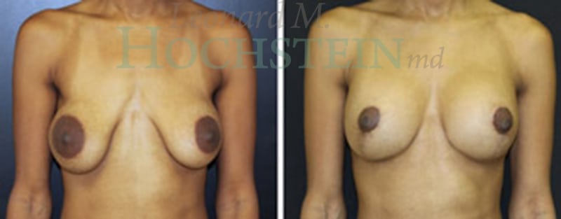 Breast Lift With Implants Patient