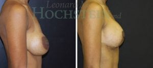 Breast Lift With Implants Patient