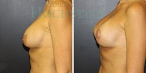 Breast Lift With Implants Patient