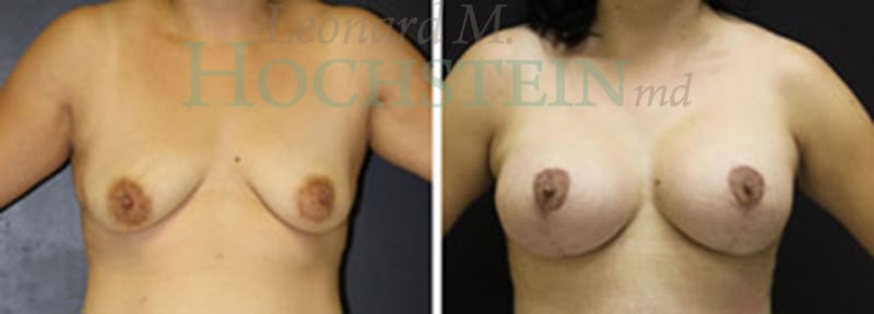 Breast Lift With Implants Patient